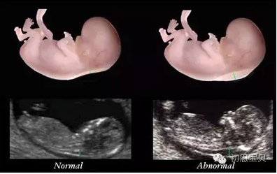 试管婴儿移植成功后孕早期为什么要做NT检查？