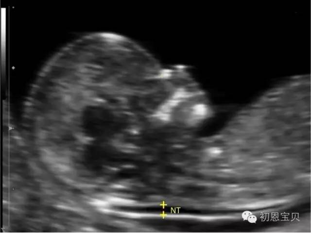 美国试管婴儿移植后，孕早期为什么要做NT检查？
