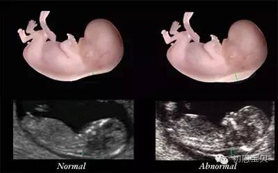 美国试管婴儿移植后，孕早期为什么要做NT检查？
